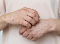 Угроза кори все нарастает — что важно знать новороссийцам об опасном заболевании