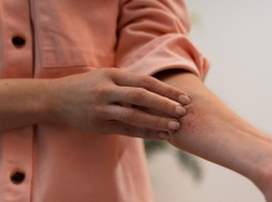 Может ли оспа обезьян добраться до Новороссийска - прогнозы врачей