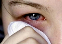 Ожоги глаз из-за кварцевой лампы получили школьники у соседей Новороссийска 