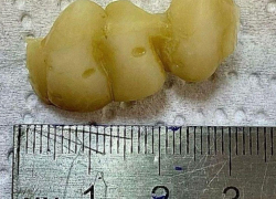 Чего только не случается: новороссиец проглотил зубной протез 