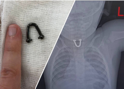 8-месячный малыш из Новороссийска проглотил "подковку" 