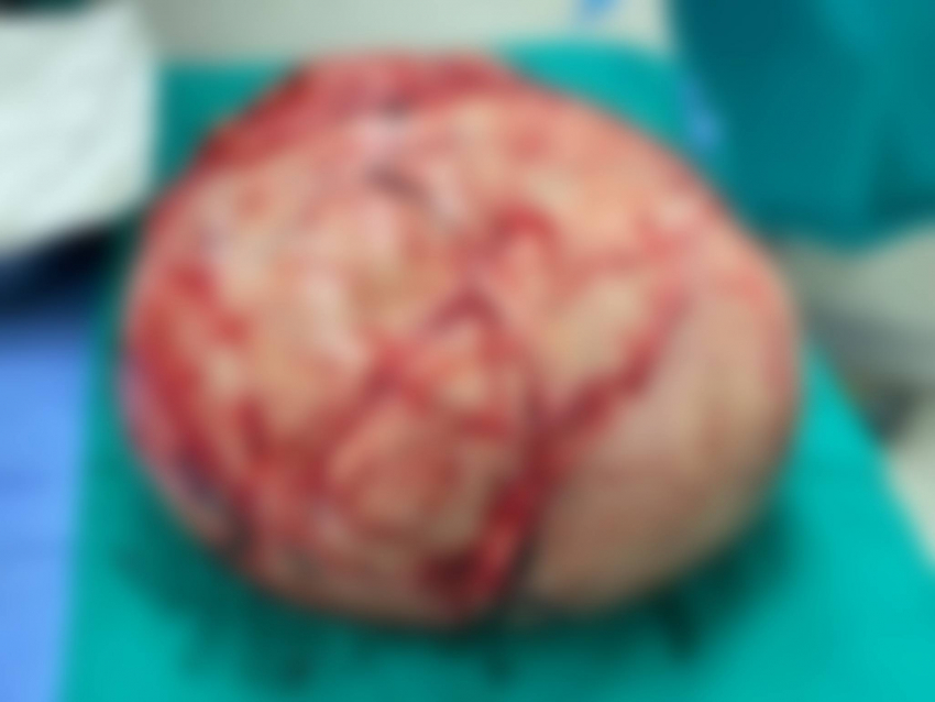 Двухкилограммовую опухоль матки удалили у жительницы Новороссийска 