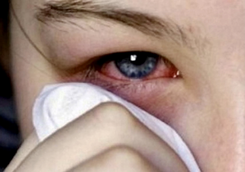 Ожоги глаз из-за кварцевой лампы получили школьники у соседей Новороссийска 