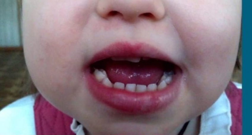 Скандал с разбитой губой в детском саду Новороссийска: правда или вымысел