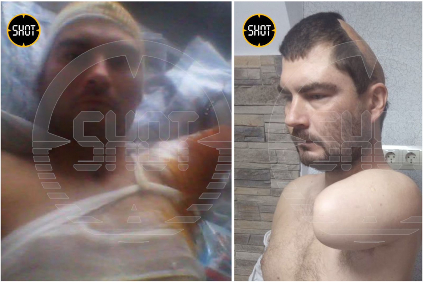 На Кубани мужчина лишился руки и части черепа из-за удара током 10 000 вольт