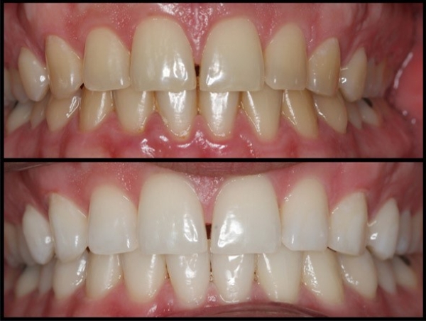Otbelivanie-zubov-sistemoi-opalescence-boost-kupit.jpg